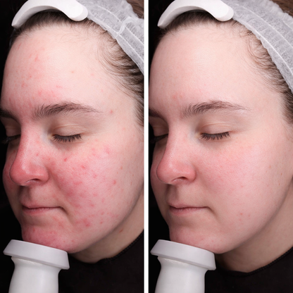 Youth Revival Ritual™ High Frequency Wand