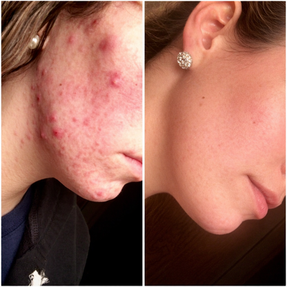 Youth Revival Ritual™ High Frequency Wand